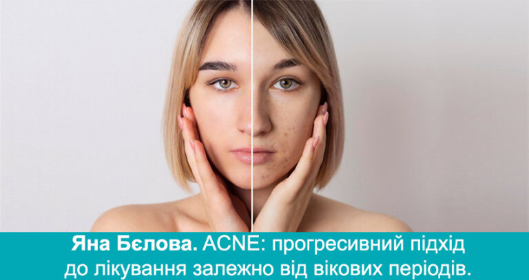Акне: прогресивний підхід до лікування залежно від вікових періодів – Яна Бєлова