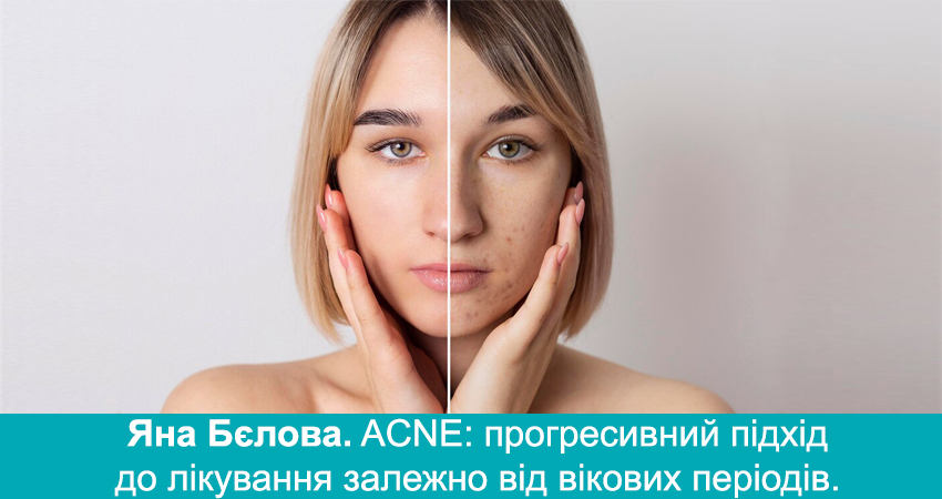 Акне: прогресивний підхід до лікування залежно від вікових періодів – Яна Бєлова