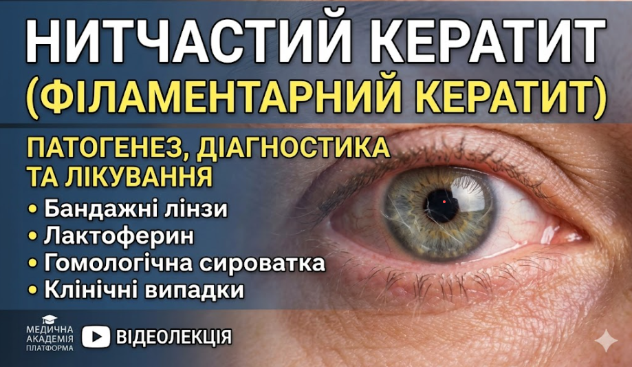 Секрети лікування філаментарного кератиту: бандажні лінзи, лактоферин та гомологічна сироватка